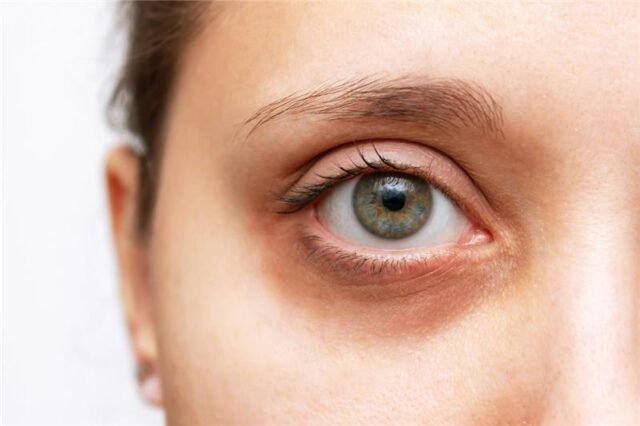What Is the Best Dark Circles Treatment