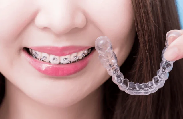 Invisalign braces