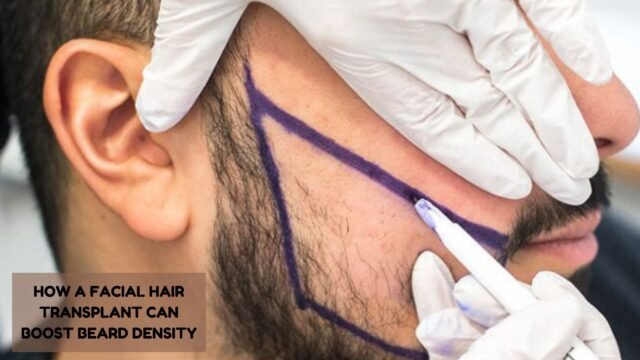 facial hair transplant