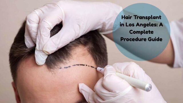 hair transplant los angeles